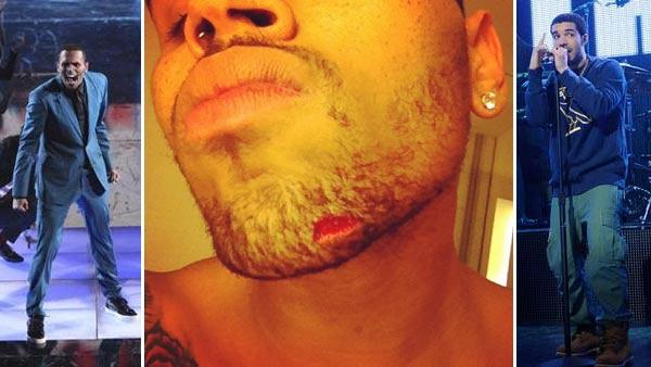 Chris Brown performs on Dancing With The Stars: The Results Show on Tuesday, May 8, 2012. / Chris Browns chin appears in a photo posted on his Twitter page on June 13, 2012. / Drake performs on the October 29, 2011 episode of Saturday Night Live. - Provided courtesy of ABC / Twitter.com/ChrisBrown / NBC Chris Brown performs on Dancing With The Stars: The Results Show on Tuesday, May 8, 2012. / Chris Browns chin appears in a photo posted on his Twitter page on June 13, 2012. / Drake performs on the October 29, 2011 episode of Saturday Night Live. - Provided courtesy of ABC / Twitter.com/ChrisBrown / NBC