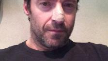 Hugh Jackman posted this photo of himself on his Instagram page on Nov. 21, 2013. He revealed he was treated for skin cancer. - Provided courtesy of instagram.com/p/g_GQqMChOX/ instagram.com/thehughjackman