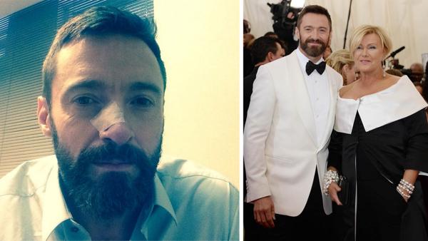 Hugh Jackman posted this photo of himself on his Instagram page on May 8, 2014, after his second skin cancer treatment. / Hugh Jackman and wife Deborra Lee appear at the Metropolitan Museum of Arts 2014 Costume Institute Benefit gala in on May 5, 2014. - Provided courtesy of instagram.com/thehughjackman / Briquet-Douliery / Abaca / Startraksphoto.com