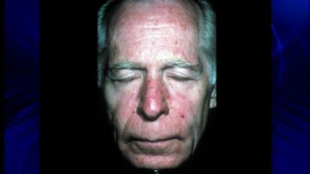 Rosacea is a skin problem causing reddening and inflammation of the face.