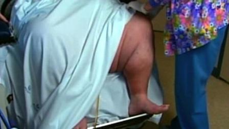 A new study of bariatric surgery suggests it doesnt melt away pounds just by rearranging the digestive tract.