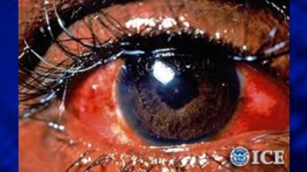 With Halloween approaching, officials are warning the public about the dangers associated with counterfeit decorative contact lenses. The Food and Drug Administrations (FDA) Office of Criminal Investigations (OCI), U.S. Immigration and Customs Enforcements (ICE) Homeland Security Investigations (HSI), and U.S. Customs and Border Protection (CBP) are working together to seize illegal and harmful versions of correctable vision lenses and decorative or color contact lenses that are illegally imported and distributed throughout the United States.
This is a photo of a damaged eys from a counterfeit contact lens.