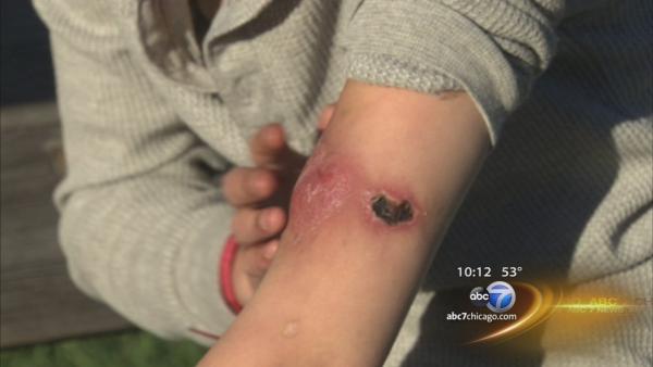 Joliet sisters hope their 'Krokodil' story a wakeup call for others; flesh-eating heroin-like drug destroys skin, lives