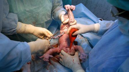 Surgeons cut the umbilical cord of a baby girl in Madras, India, Wednesday, May 31, 2006. (AP Photo/M. Lakshman)