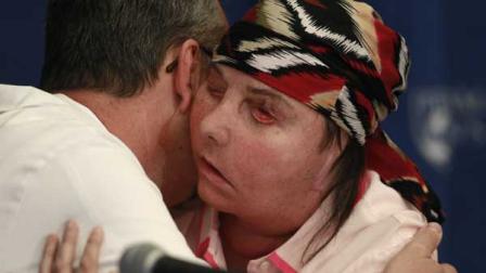 Carmen Blandin Tarleton of Thetford, Vt., embraces her surgeon, Dr. Bohdan Pomahac, during a news conference at Brigham and Womens Hospital in Boston, Mass., Wednesday, May 1, 2013. The 44-year-old mother of two underwent a successful face transplant in February after a 2007 attack in which her estranged husband doused her with industrial strength lye, burning more than 80 percent of her body.