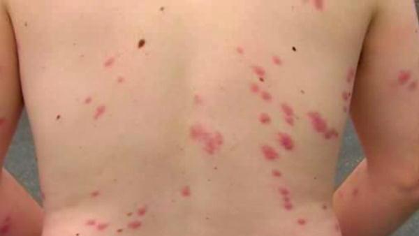 Bed Bug Bites, Rashes & Symptoms - orkin.com