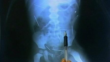 X-ray of needles in Brazilian boy.