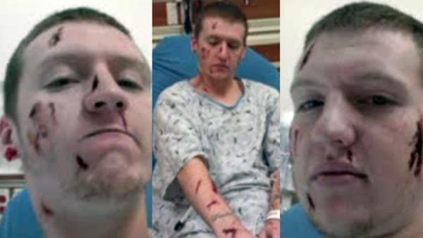 Man attacked by coyotes on way to work