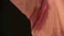 Underarm sweating