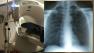 Chest X-ray