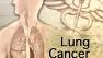 Lung Cancer