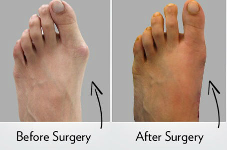 Cinderella Foot Surgery | LA Foot Doc | Dr. Jamfeet