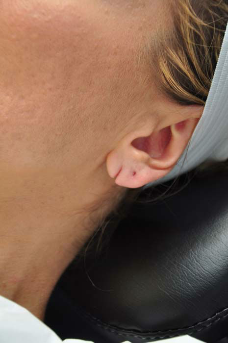 20 minute procedure can repair ripped earlobes | abc13.com