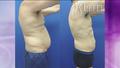 lipo